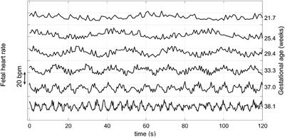 A Proxy for Detecting IUGR Based on Gestational <mark class="highlighted">Age Estimation</mark> in a Guatemalan Rural Population